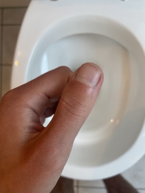 Eigenurintherapie